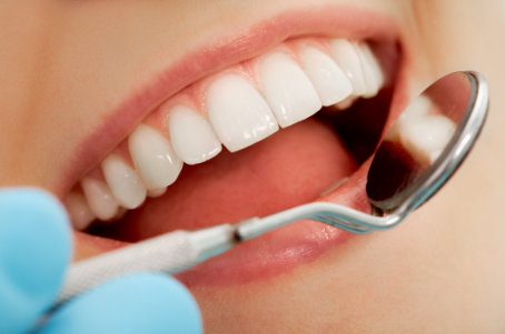 white teeth fillings
